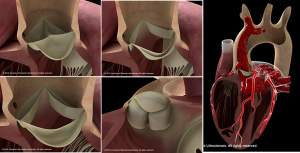 Preview Basic Aortic Pictures