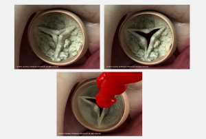 Aortic Calcification